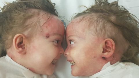 El llamamiento de Carla y Noa en tiempos de coronavirus, las gemelas de cinco años con 'piel de mariposa' 
